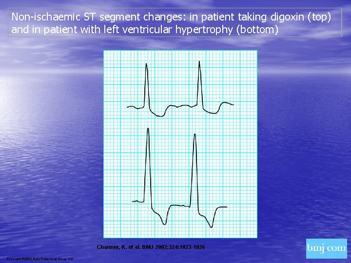 Non-ischaemic ST segment changes: in patient taking digoxin (top) and in patient with left
