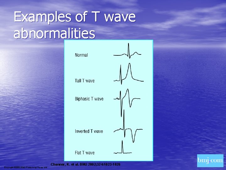 Examples of T wave abnormalities Copyright © 2002 BMJ Publishing Group Ltd. Channer, K.