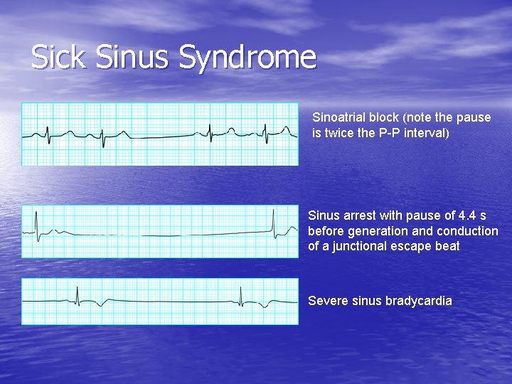 Sick Sinus Syndrome Sinoatrial block (note the pause is twice the P-P interval) Sinus