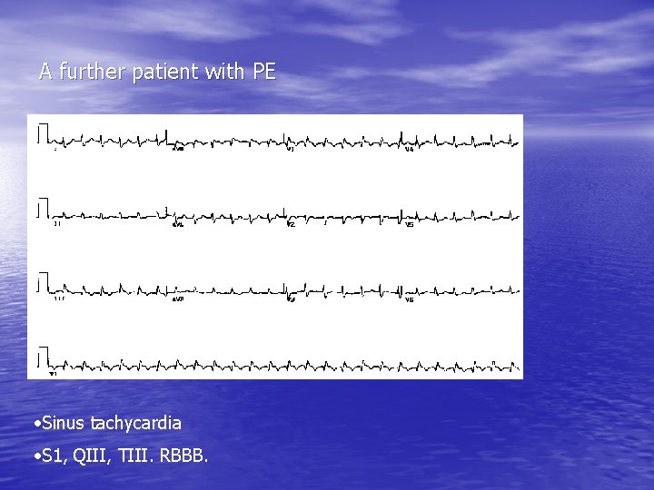 A further patient with PE • Sinus tachycardia • S 1, QIII, TIII. RBBB.