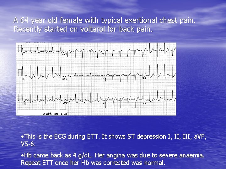 A 64 year old female with typical exertional chest pain. Recently started on voltarol