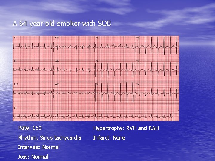 A 64 year old smoker with SOB Rate: 150 Hypertrophy: RVH and RAH Rhythm: