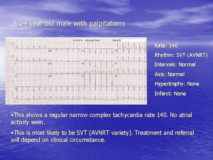 A 24 year old male with palpitations Rate: 140 Rhythm: SVT (AVNRT) Intervals: Normal