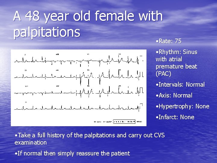 A 48 year old female with palpitations • Rate: 75 • Rhythm: Sinus with