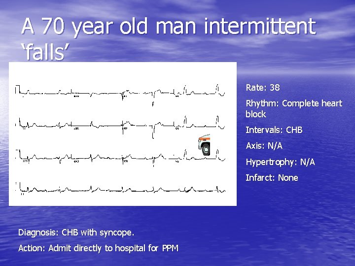 A 70 year old man intermittent ‘falls’ Rate: 38 Rhythm: Complete heart block Intervals: