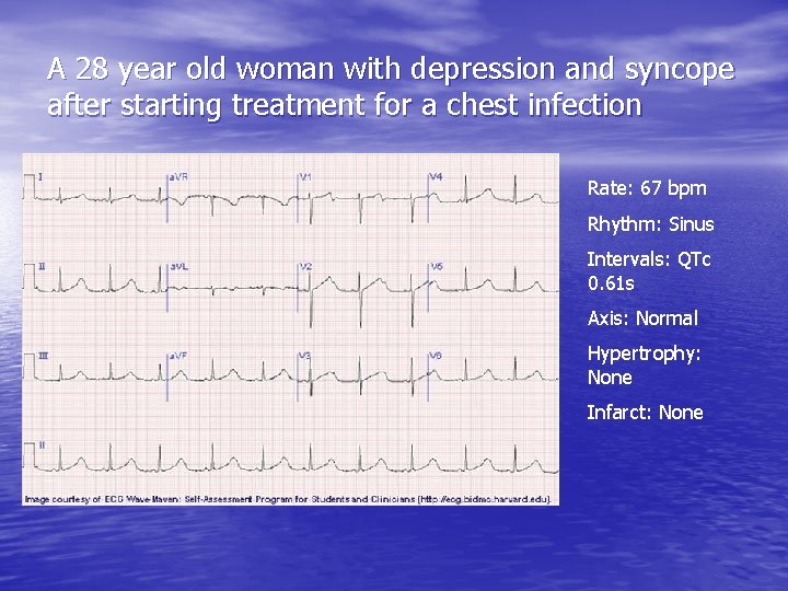 A 28 year old woman with depression and syncope after starting treatment for a
