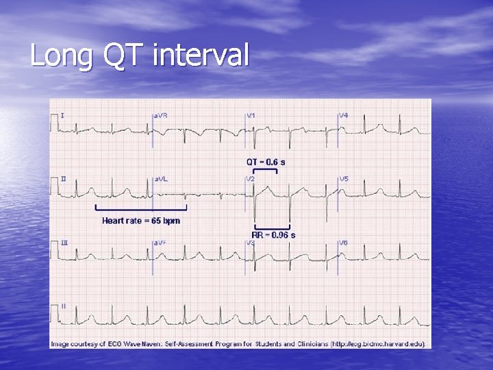 Long QT interval 