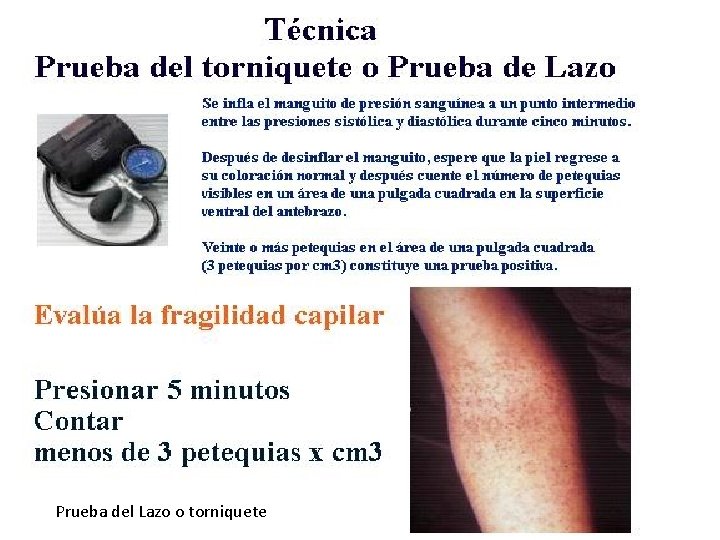 Prueba del Lazo o torniquete 