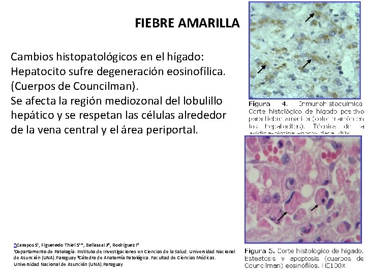 FIEBRE AMARILLA Cambios histopatológicos en el hígado: Hepatocito sufre degeneración eosinofílica. (Cuerpos de Councilman).