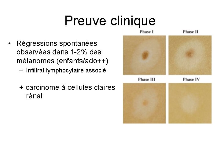 Preuve clinique • Régressions spontanées observées dans 1 -2% des mélanomes (enfants/ado++) – Infiltrat