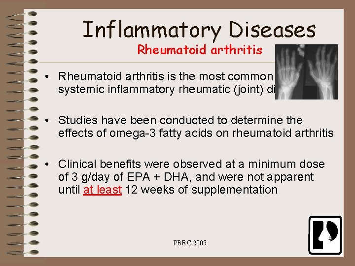 Inflammatory Diseases Rheumatoid arthritis • Rheumatoid arthritis is the most common systemic inflammatory rheumatic
