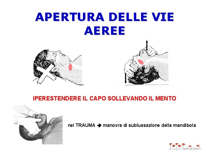 APERTURA DELLE VIE AEREE IPERESTENDERE IL CAPO SOLLEVANDO IL MENTO nel TRAUMA manovra di