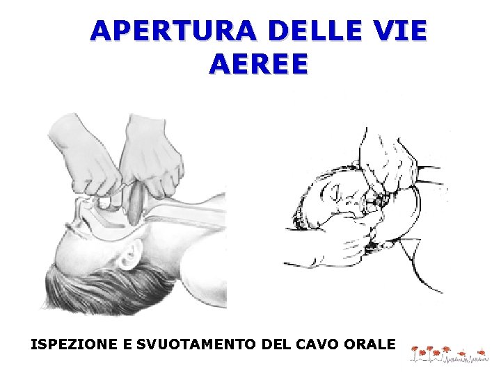 APERTURA DELLE VIE AEREE ISPEZIONE E SVUOTAMENTO DEL CAVO ORALE 