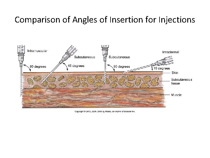 Comparison of Angles of Insertion for Injections 