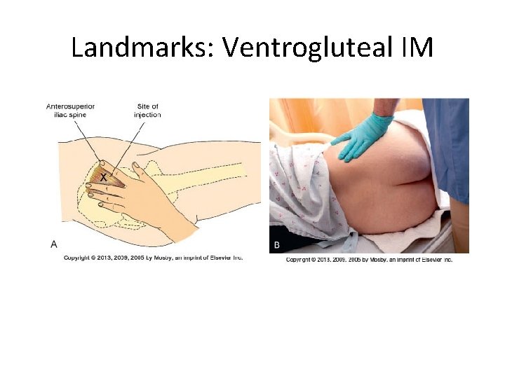 Landmarks: Ventrogluteal IM 