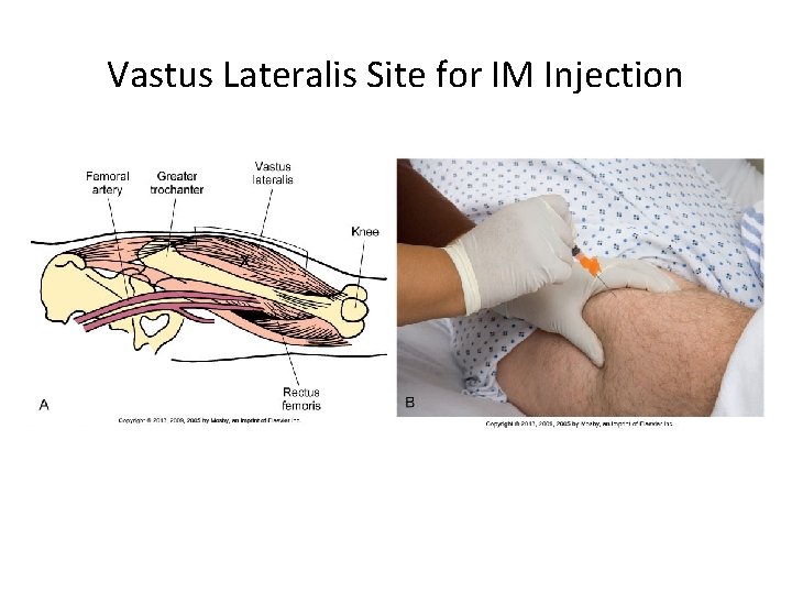 Vastus Lateralis Site for IM Injection 