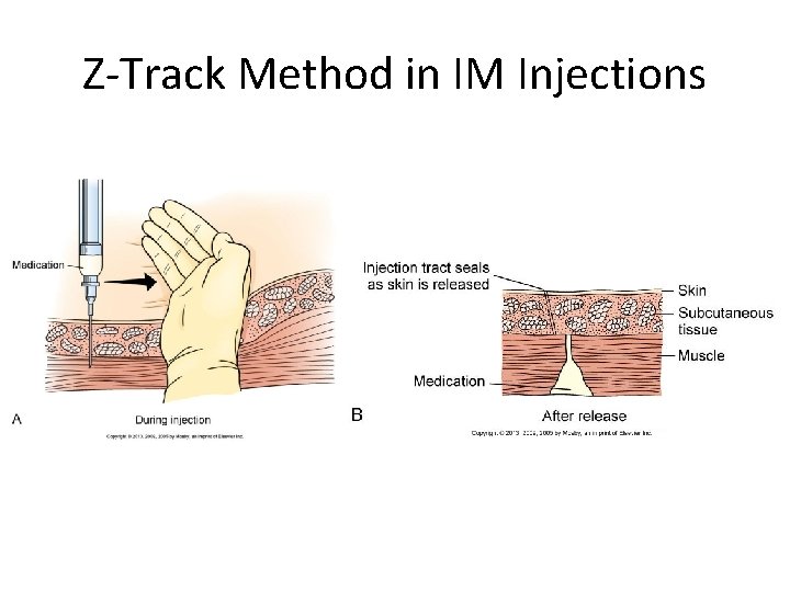 Z-Track Method in IM Injections 