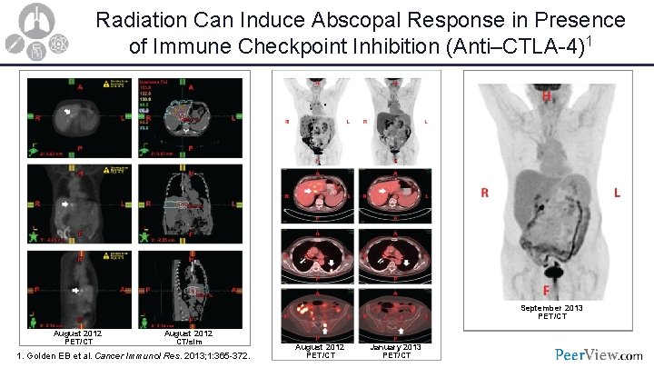 Radiation Can Induce Abscopal Response in Presence of Immune Checkpoint Inhibition (Anti–CTLA-4)1 September 2013