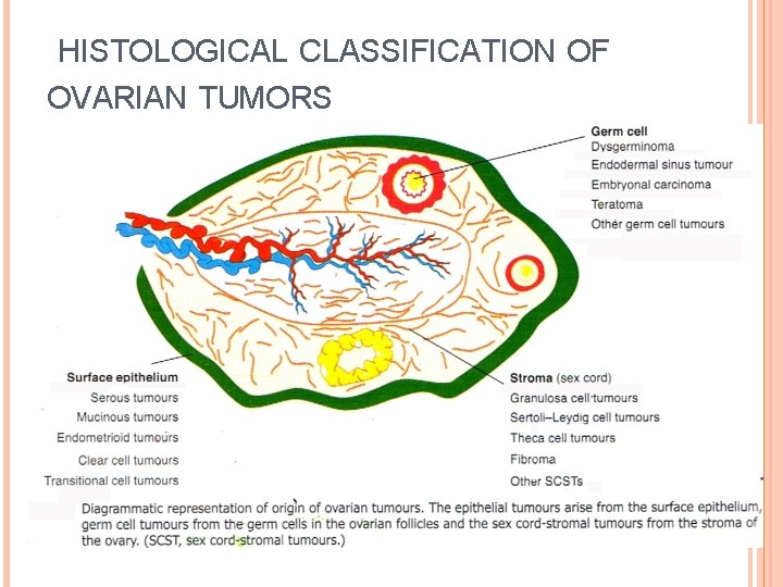 HISTOLOGICAL CLASSIFICATION OF OVARIAN TUMORS 