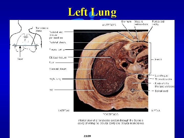 Left Lung 