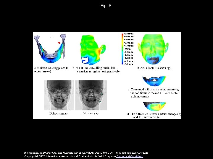 Fig. 8 International Journal of Oral and Maxillofacial Surgery 2007 36640 -645 DOI: (10.