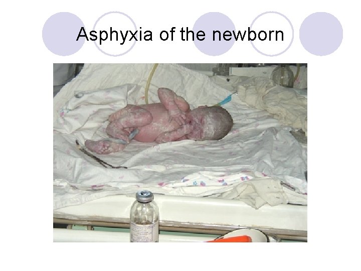 Asphyxia of the newborn 