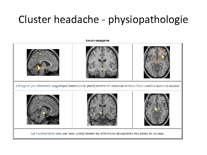 Cluster headache - physiopathologie 