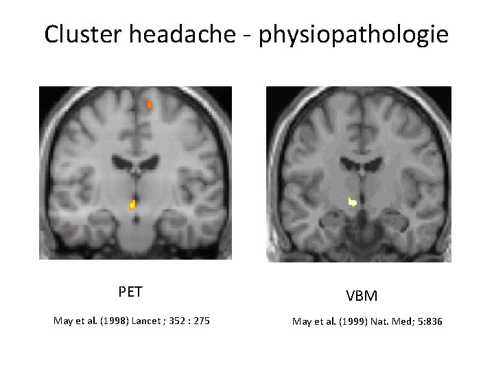 Cluster headache - physiopathologie PET May et al. (1998) Lancet ; 352 : 275