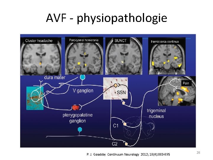 AVF - physiopathologie P. J. Goadsby Continuum Neurology 2012; 18(4): 883 -895 28 