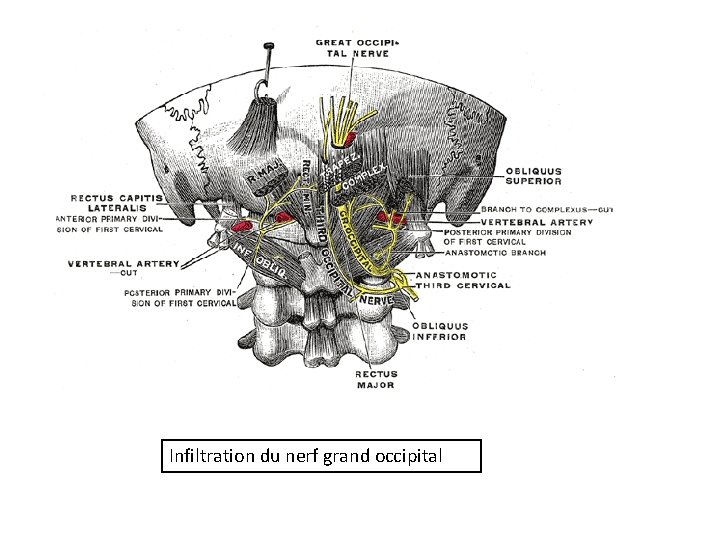 Infiltration du nerf grand occipital 