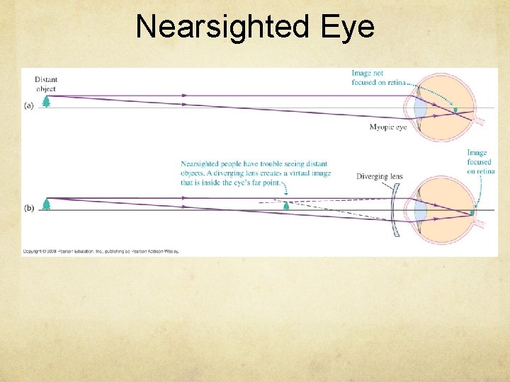 Nearsighted Eye 