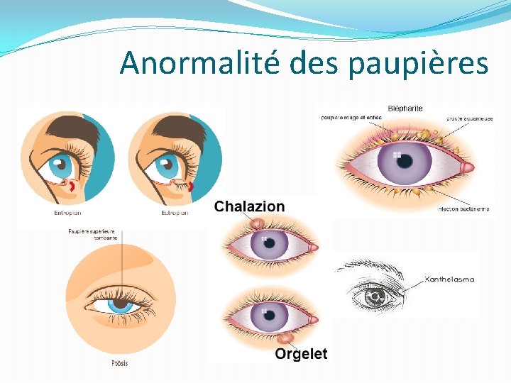 Anormalité des paupières Anormalité des paupières