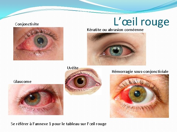 L’œil rouge Conjonctivite Kératite ou abrasion cornéenne Uvéite Glaucome Se référer à l’annexe 1 L’œil rouge Conjonctivite Kératite ou abrasion cornéenne Uvéite Glaucome Se référer à l’annexe 1