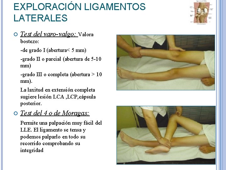 EXPLORACIÓN LIGAMENTOS LATERALES Test del varo-valgo: Valora bostezo: -de grado I (abertura< 5 mm) EXPLORACIÓN LIGAMENTOS LATERALES Test del varo-valgo: Valora bostezo: -de grado I (abertura< 5 mm)