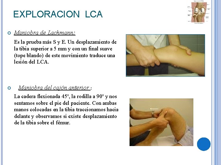 EXPLORACION LCA Maniobra de Lachmann: Es la prueba más S y E. Un desplazamiento EXPLORACION LCA Maniobra de Lachmann: Es la prueba más S y E. Un desplazamiento