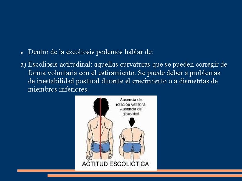  Dentro de la escoliosis podemos hablar de: a) Escoliosis actitudinal: aquellas curvaturas que