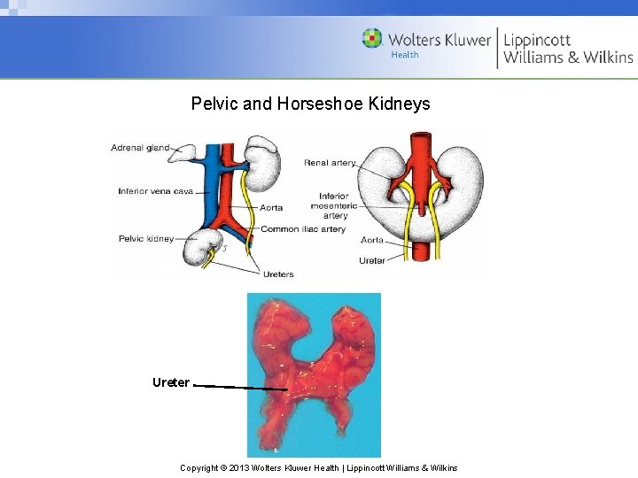 Pelvic and Horseshoe Kidneys Ureter Copyright © 2013 Wolters Kluwer Health | Lippincott Williams
