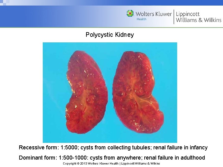 Polycystic Kidney Recessive form: 1: 5000; cysts from collecting tubules; renal failure in infancy