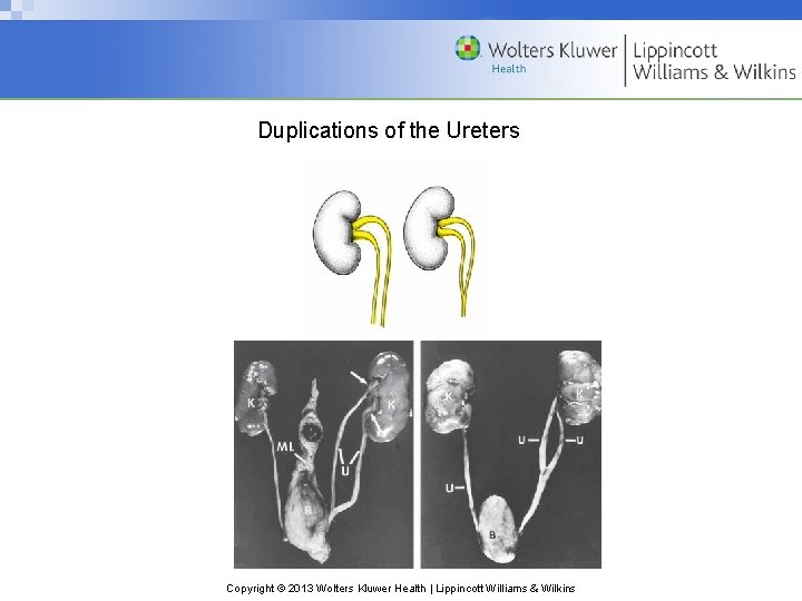 Duplications of the Ureters Copyright © 2013 Wolters Kluwer Health | Lippincott Williams &