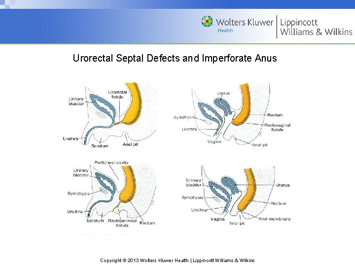 Urorectal Septal Defects and Imperforate Anus Copyright © 2013 Wolters Kluwer Health | Lippincott