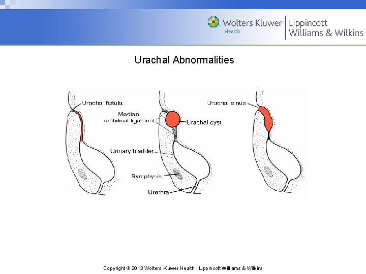 Urachal Abnormalities Copyright © 2013 Wolters Kluwer Health | Lippincott Williams & Wilkins 