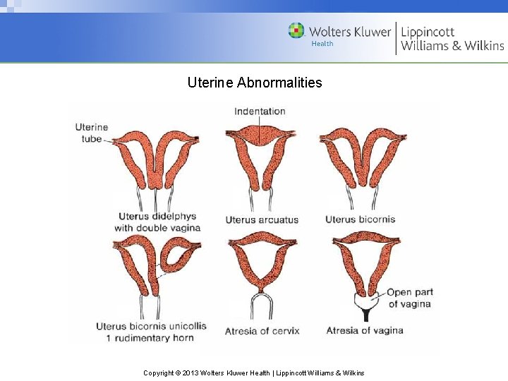 Uterine Abnormalities Copyright © 2013 Wolters Kluwer Health | Lippincott Williams & Wilkins 