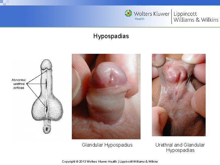 Hypospadias Glandular Hypospadius Urethral and Glandular Hypospadias Copyright © 2013 Wolters Kluwer Health |