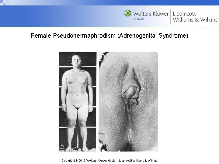 Female Pseudohermaphrodism (Adrenogenital Syndrome) Copyright © 2013 Wolters Kluwer Health | Lippincott Williams &