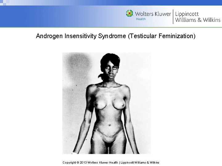 Androgen Insensitivity Syndrome (Testicular Feminization) Copyright © 2013 Wolters Kluwer Health | Lippincott Williams