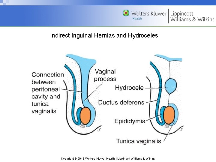 Indirect Inguinal Hernias and Hydroceles Copyright © 2013 Wolters Kluwer Health | Lippincott Williams