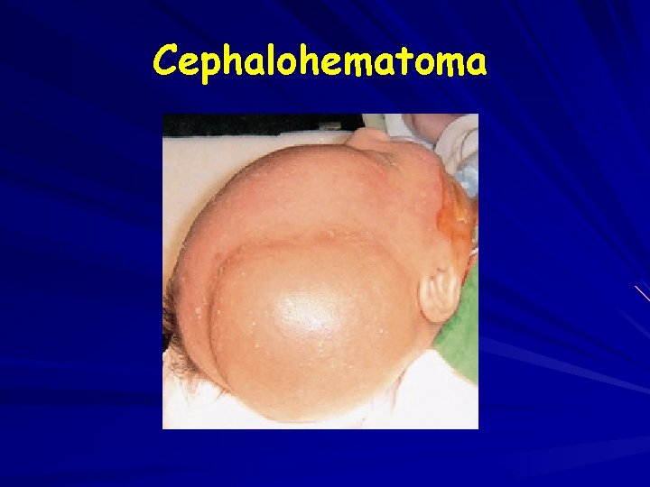 Cephalohematoma 