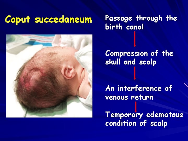 Caput succedaneum Passage through the birth canal Compression of the skull and scalp An