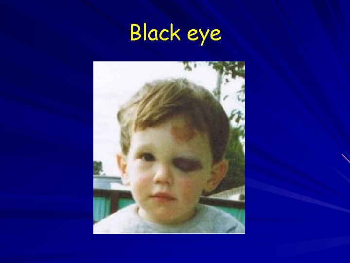 Black eye 