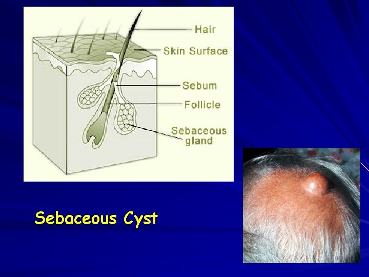 Sebaceous Cyst 